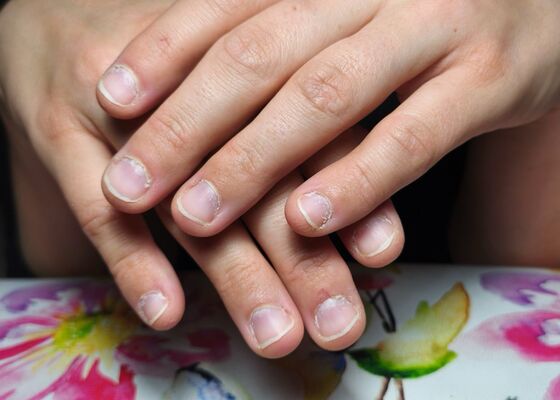 Nehty víceméně bez zásadních problémů (stav před) | Proměny nehtů